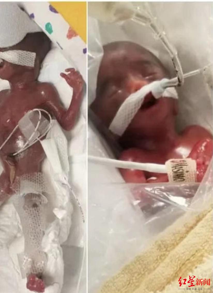 胎龄仅22周,被认为"存活几率为0"!