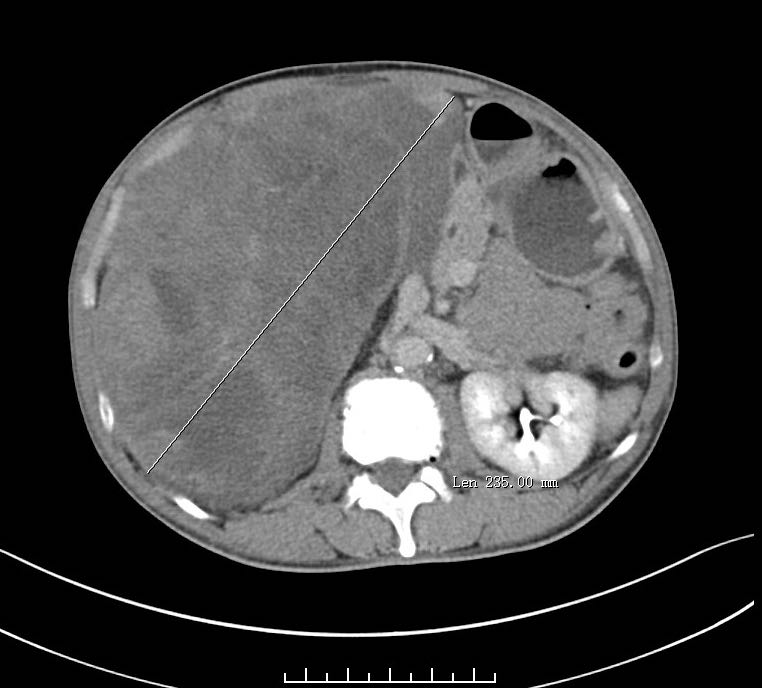 术前ct检查提示,老人体内有巨大的腹膜后肿瘤.