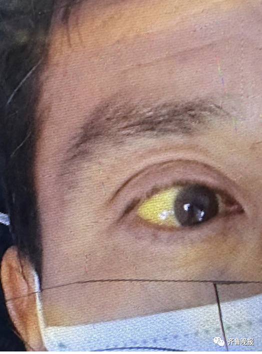 病发时杨顺才的眼白变成了明黄色