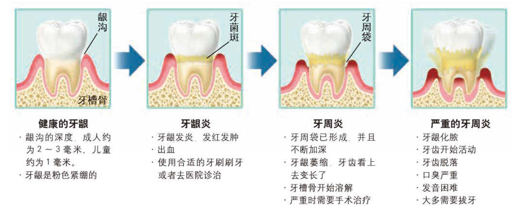 牙周病是如何一步步找上你的？