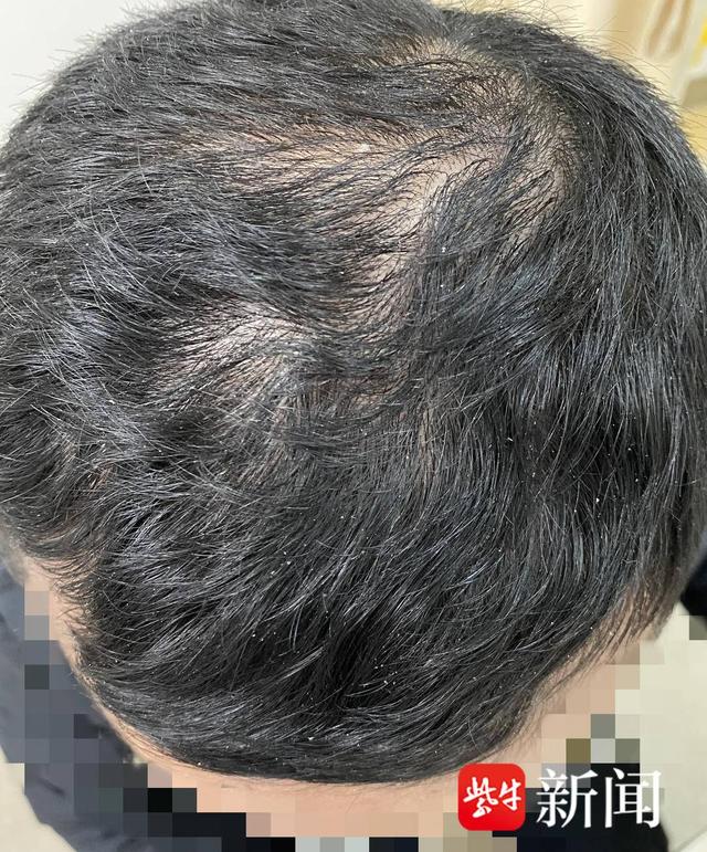 00后初中生都来看脱发门诊了,这届年轻人是怎么“秃”的,又该怎么防?__财经头条