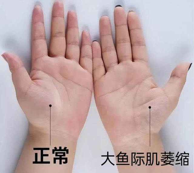 腕管神经压迫术后五十天能干点轻活吗?