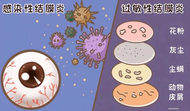 春季眼痒？可能是过敏性结膜炎惹的祸！