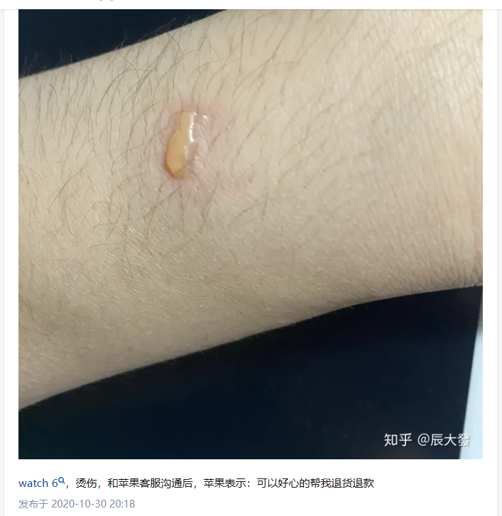 苹果手表致使多名用户手腕红肿,甚至曾发热爆炸,涉及多个型号_手机新浪网