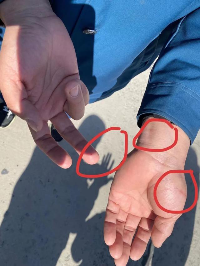 公交司机葛红彬手上被玻璃划伤的裂口仍依稀可见.