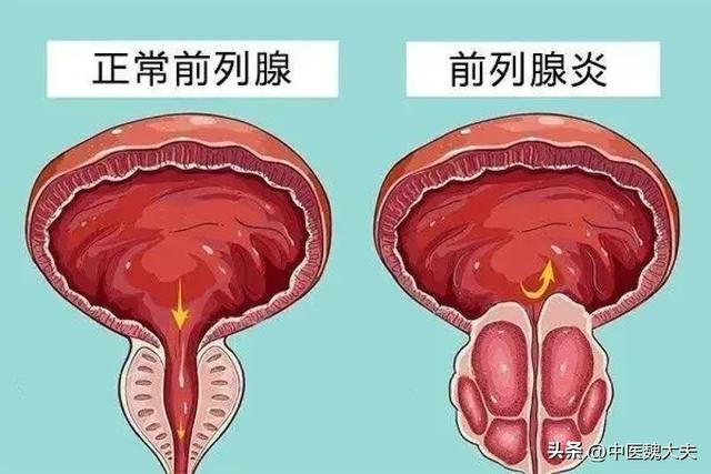 得了前列腺炎怎么办?难治疗吗?医生告诉你