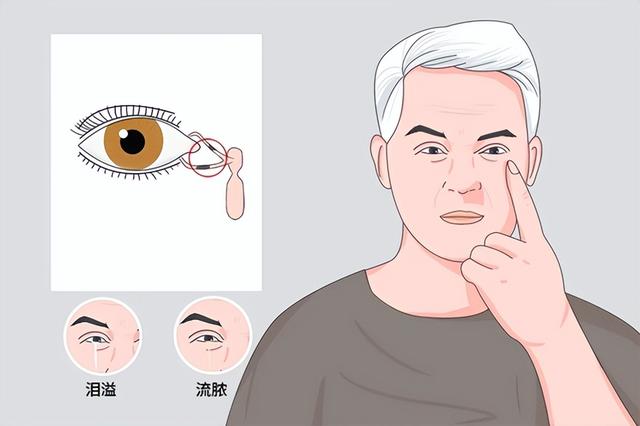 明明没有伤心事,却总在流眼泪?小心是泪道病在“搞鬼”__财经头条