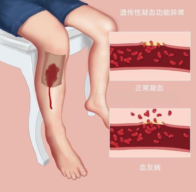 皮肤粘膜出血,皮下组织,后背出血;血友病患者易出现以下症状:每年的4