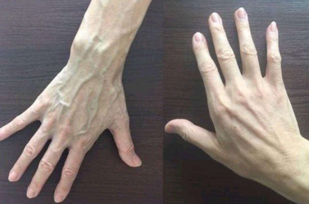 就是手背部青筋明显,因为血管硬化了,就会发青增粗,尤其是手背的中焦