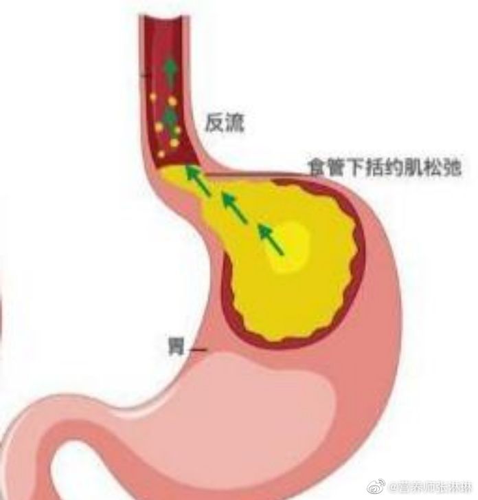 关于胃食管反流病，你知道多少？
