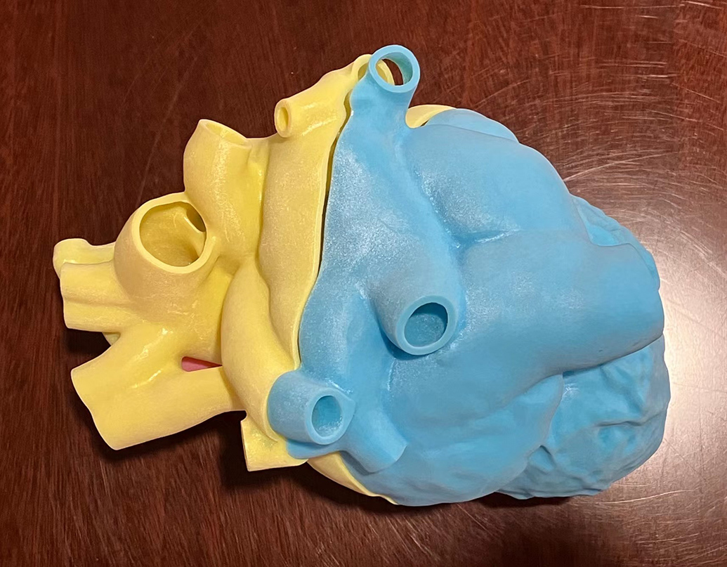 3d打印的患者心脏模型