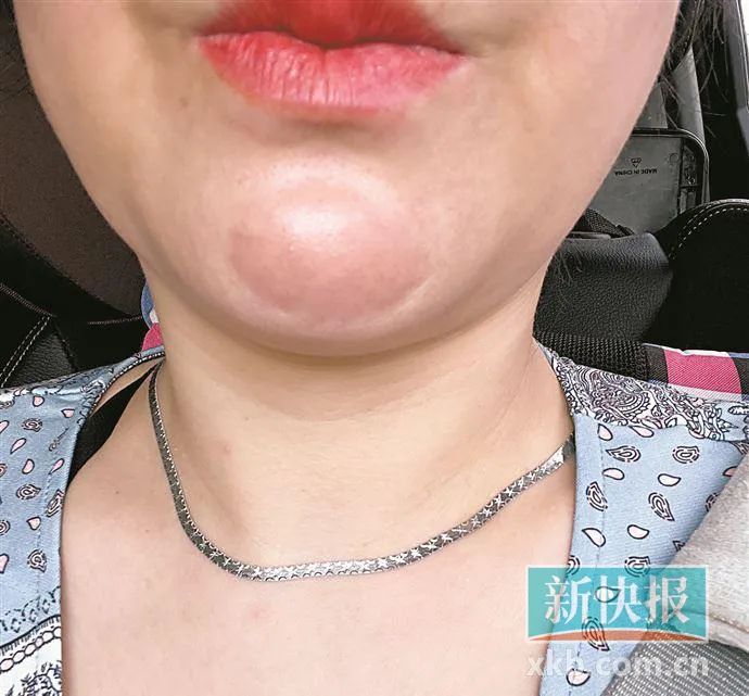 韩女士下巴处可见明显突起.