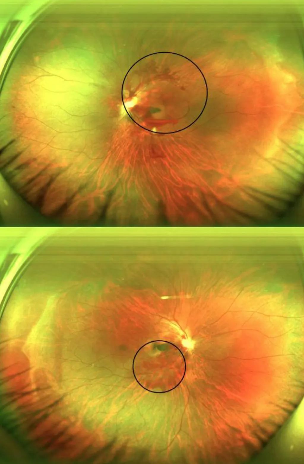 眼底照片显示患者双眼出现眼底出血症状.