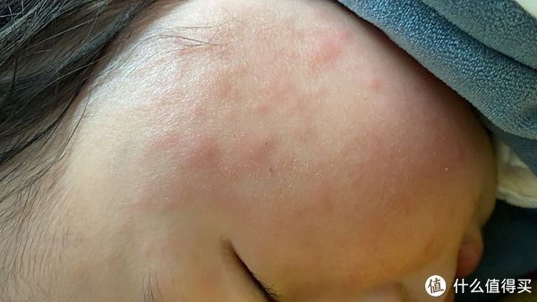 敏宝宝的春天有点费妈|消炎|过敏|疹子_新浪新闻