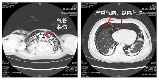 患儿的胸部ct 上海交通大学医学院附属新华医院 供图