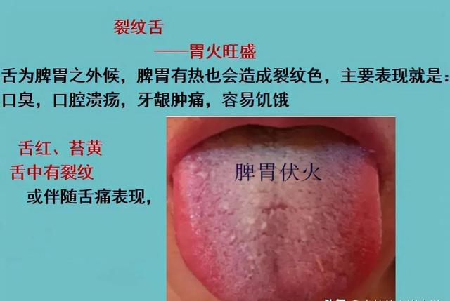裂纹舌的调理__财经头条