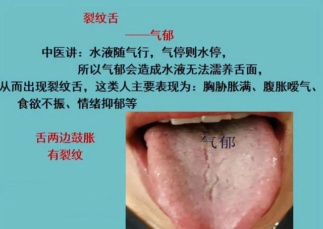 裂纹舌的调理__财经头条