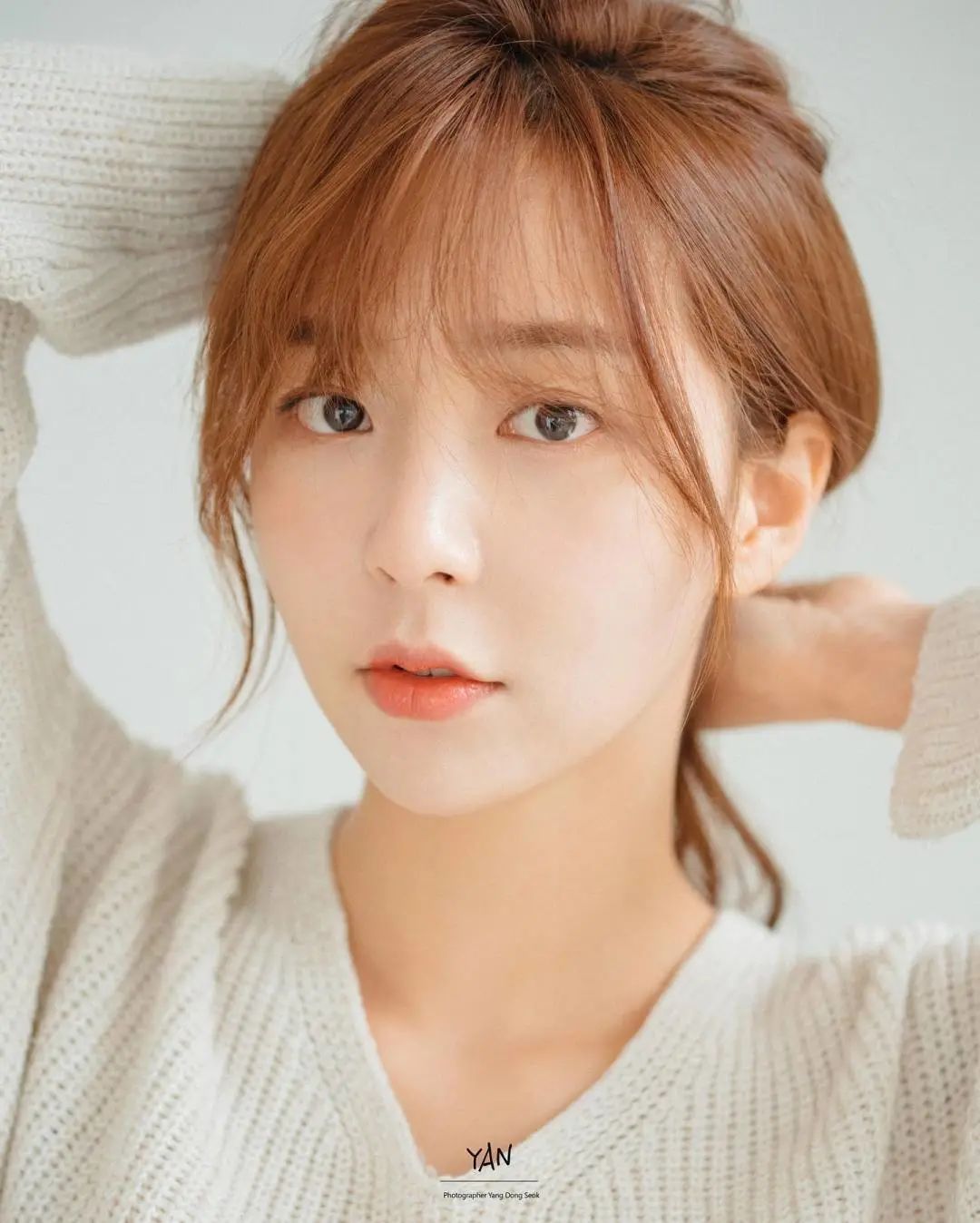 北京圣贝口腔金属矫正：整牙370天，华丽蜕变无死角“上镜脸”！