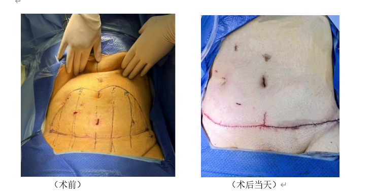 男子手术减重80斤腹部皮肤垂到大腿,接受腹壁整形手术|手术_新浪财经
