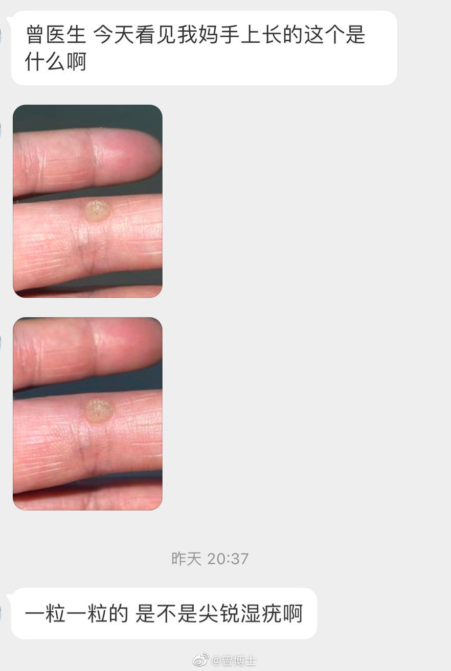 尖锐湿疣是什么 尖锐湿疣的颜色变化是怎么回事