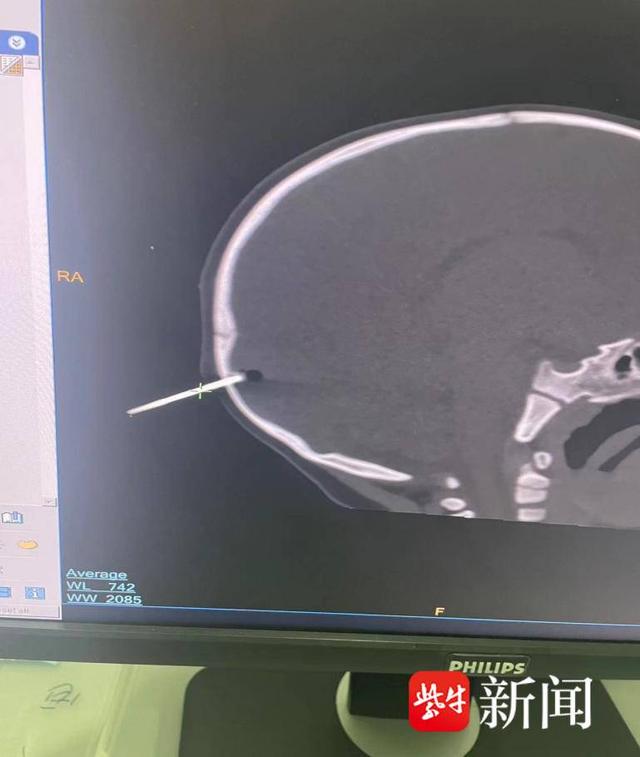 注射物取出鼻梁会很皱吗？！