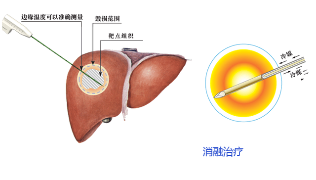 肝癌消融治疗和介入治疗有什么不一样