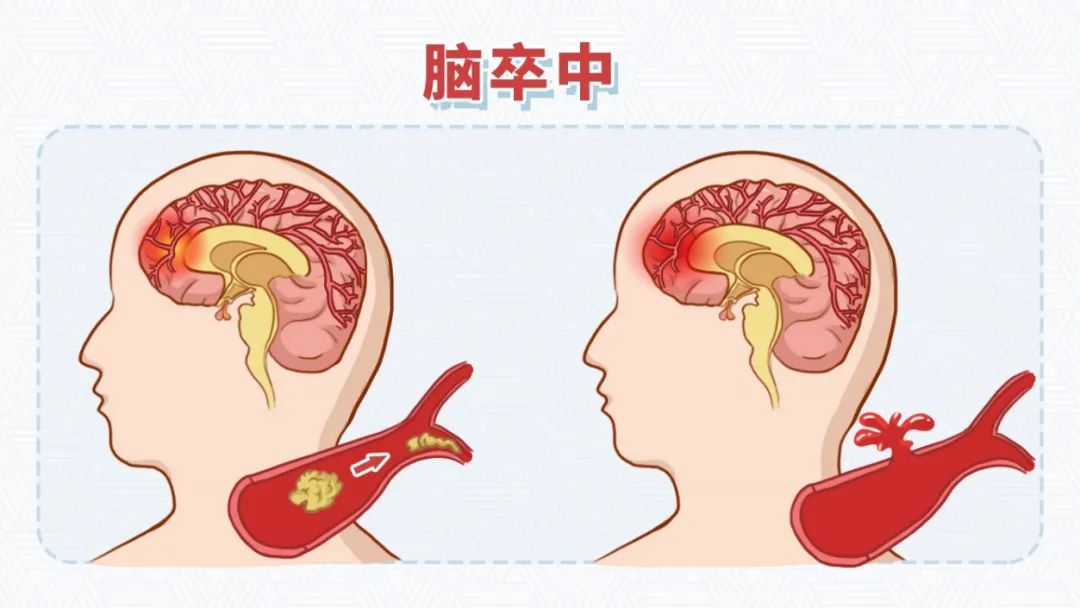 低频电刺激是什么它被称为健康的“头号杀手”，这 5 个治疗方法很有效，先收藏！_https://www.jmylbn.com_新闻资讯_第1张
