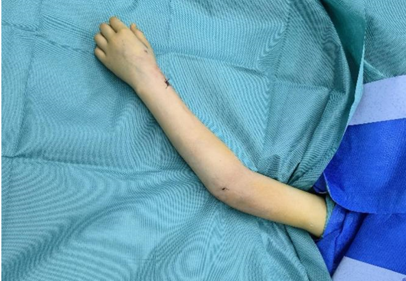 9岁女童不慎摔伤骨折 医生8mm微创接骨__财经头条