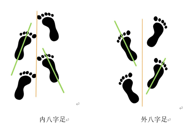 内,外八字足步态示意图.本文作者供图