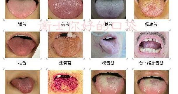 中医常见舌诊，比较全|舌苔|舌面|舌质|舌体|满布_新浪新闻