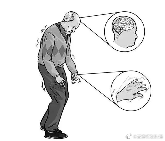维生素A对帕金森病患者的神经保护作用体现在哪些方面?