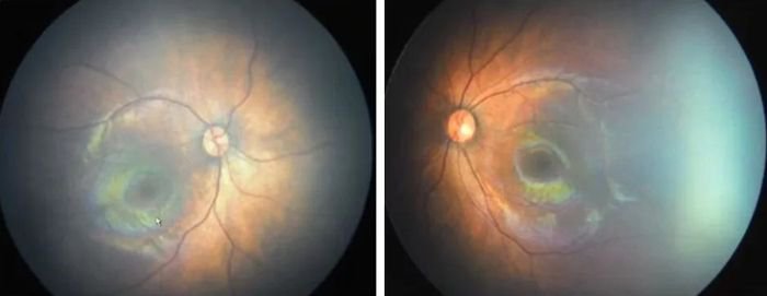 正常的婴儿眼底图