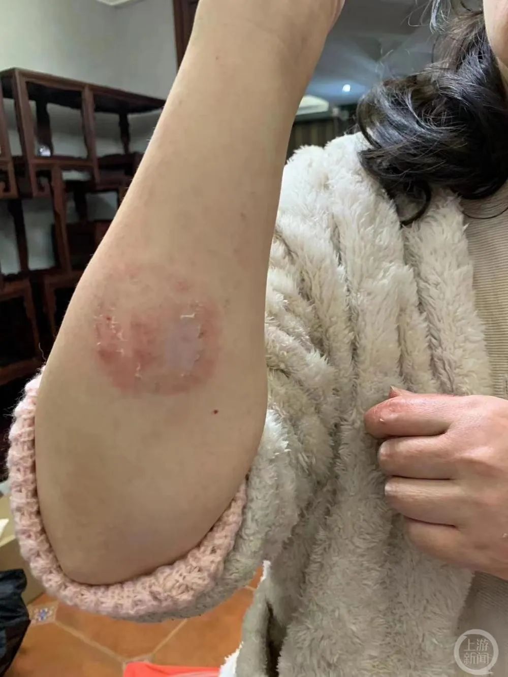 刘女士称,她再次遭到丈夫家暴,手臂,腹部等出现多处淤青