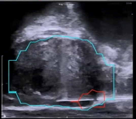 磁共振/超声融合靶向穿刺技术示意图。图片来源：BK ultrasound