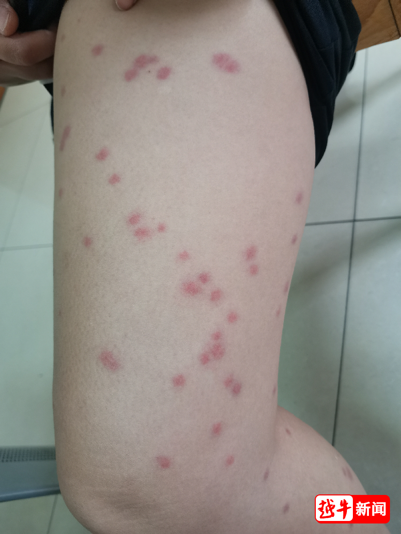 洗澡后皮肤为什么会痒 皮肤瘙痒用什么洗澡才合适