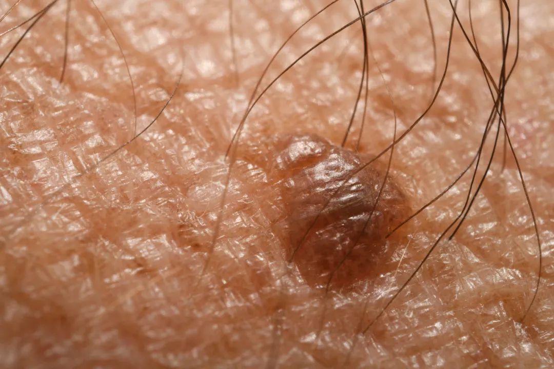 由于痣细胞的色素含量不同,临床上可呈棕色,褐色,蓝黑色,黑色或正常