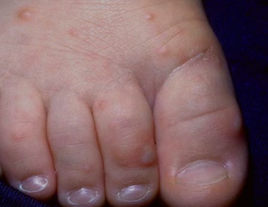 手足口病患儿症状 图/受访者提供