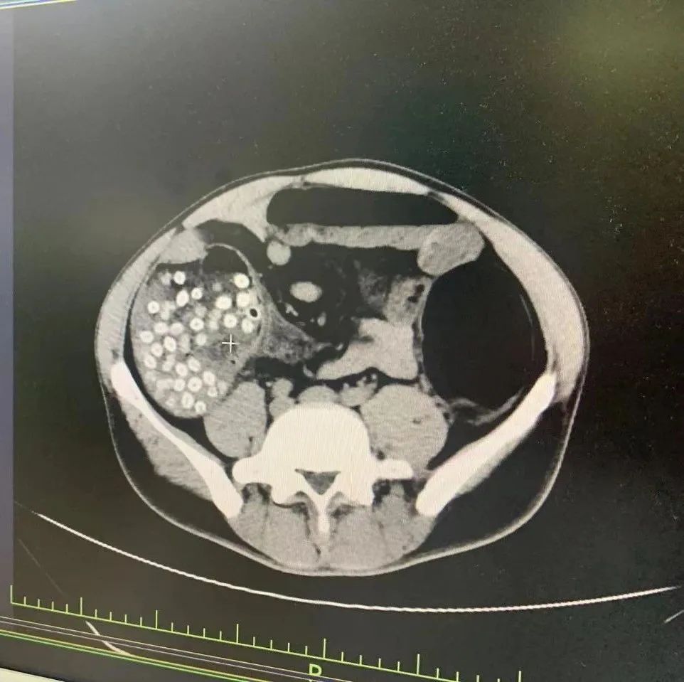 肠梗阻_新浪财经_新浪网