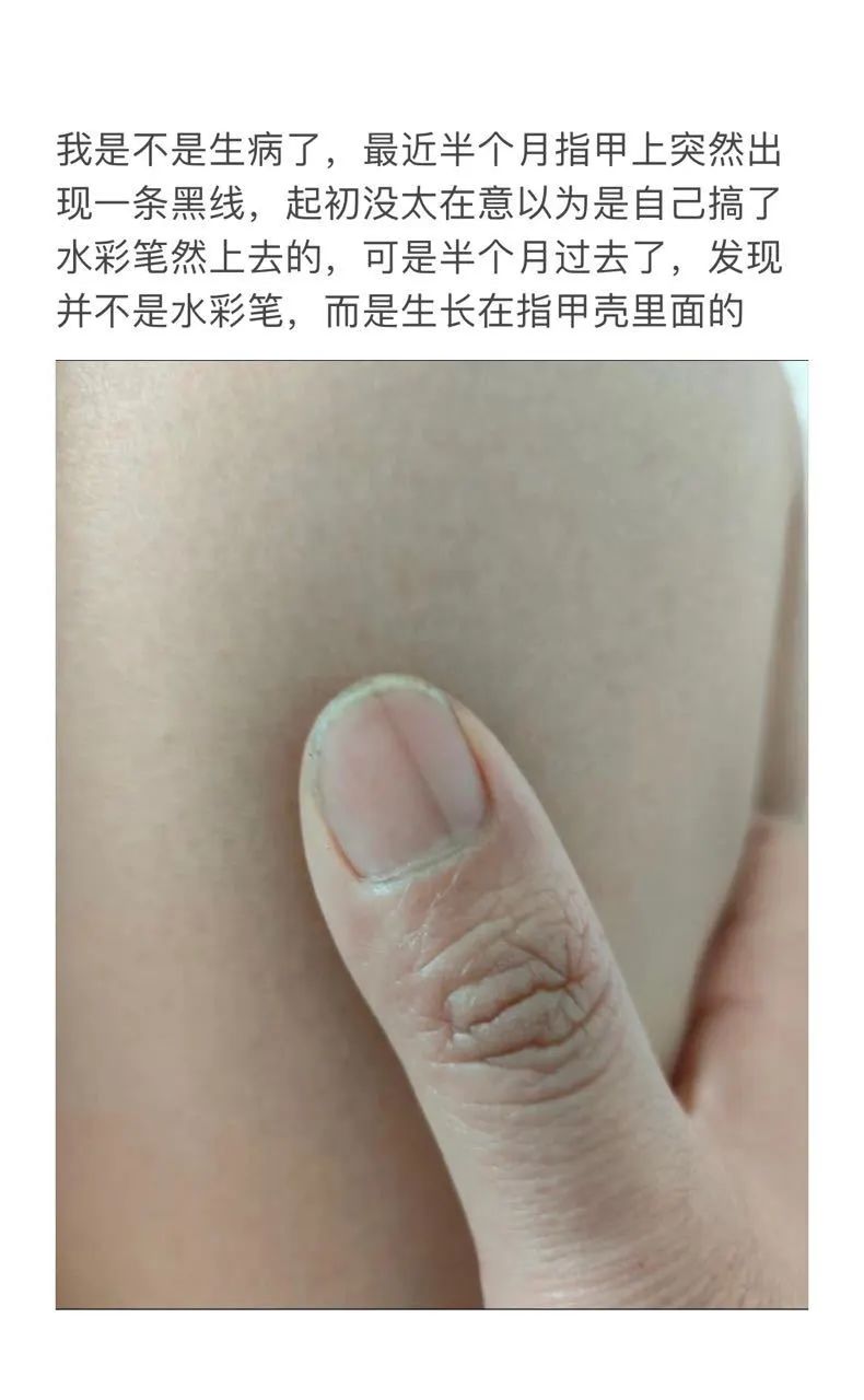 指甲上突然长了一条黑线,网友慌了!|黑色素瘤_新浪财经_新浪网