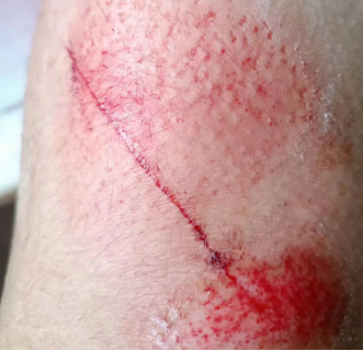 摔伤的腿.图片由受访者提供