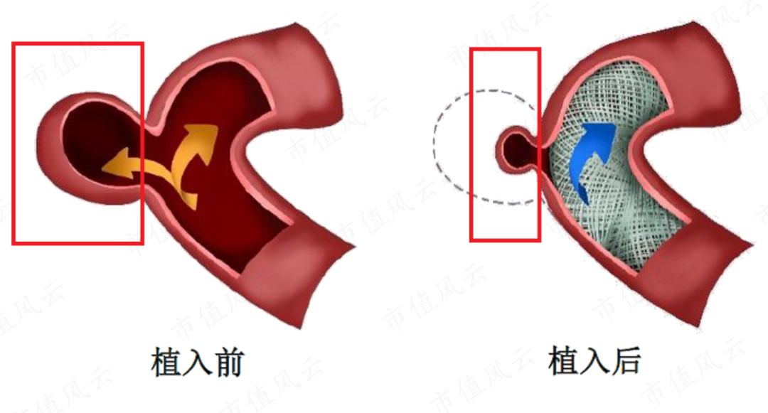 新手怎么学医疗器械零营收，负现金流，神经介入医疗器械新手艾柯医疗：刚上牌桌就深陷红海，先圈10亿不过分吧？_https://www.jmylbn.com_新闻资讯_第8张