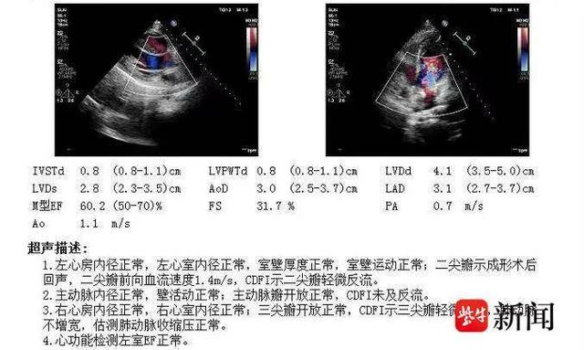 彩超报告单记者了解到,心脏术后第3天,小张顺利从icu转回了普通病房