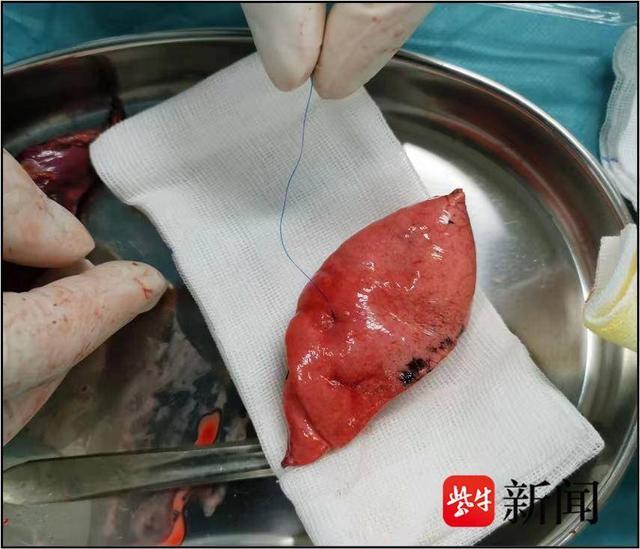 【医线见闻】查出肺结节,到底切还是不切|手术_新浪财经_新浪网