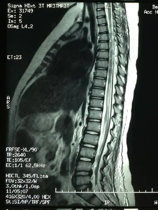 瘫痪病人怎么护理视频3周内接诊5例，教育部、中消协发出提醒！“下腰瘫”是怎么回事？_https://www.jmylbn.com_新闻资讯_第6张