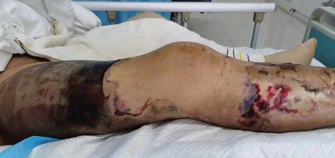 坏死性筋膜炎诊治的研究进展[j]. 国际骨科学杂志, 2020, 41(5):4.