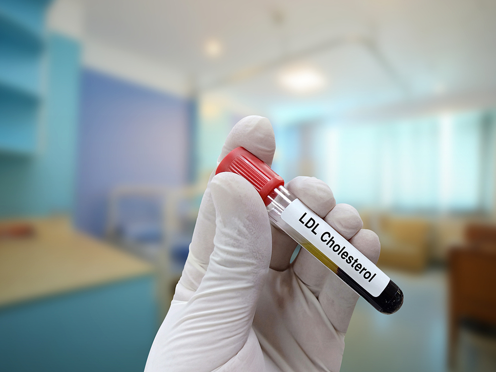 用于低密度脂蛋白胆固醇测试的血样.视觉中国&nbsp; 图