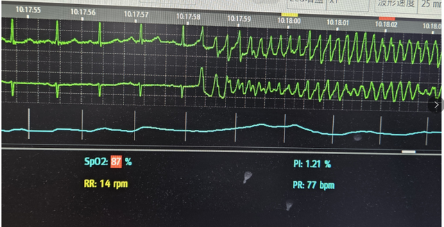 循声望去,发现龚大爷的心电图波显示不规则的颤动波,"窦性心律"瞬间变