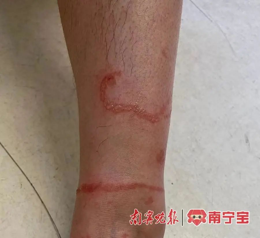 孩子被红火蚁咬伤,被海蜇蜇伤,紧急提醒