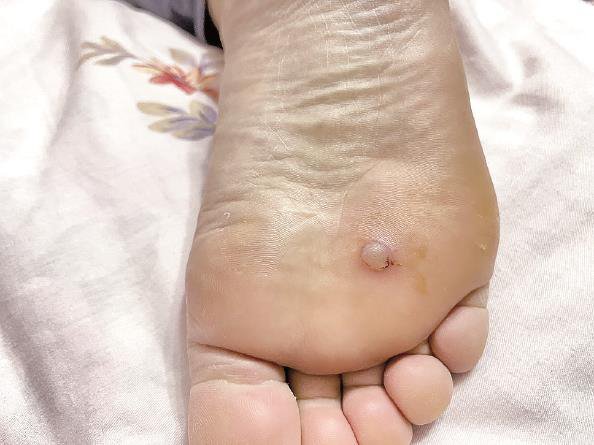 将车停到地下车库,取车时踩到地面裸露的两颗"钉子",鞋子被扎穿,脚掌