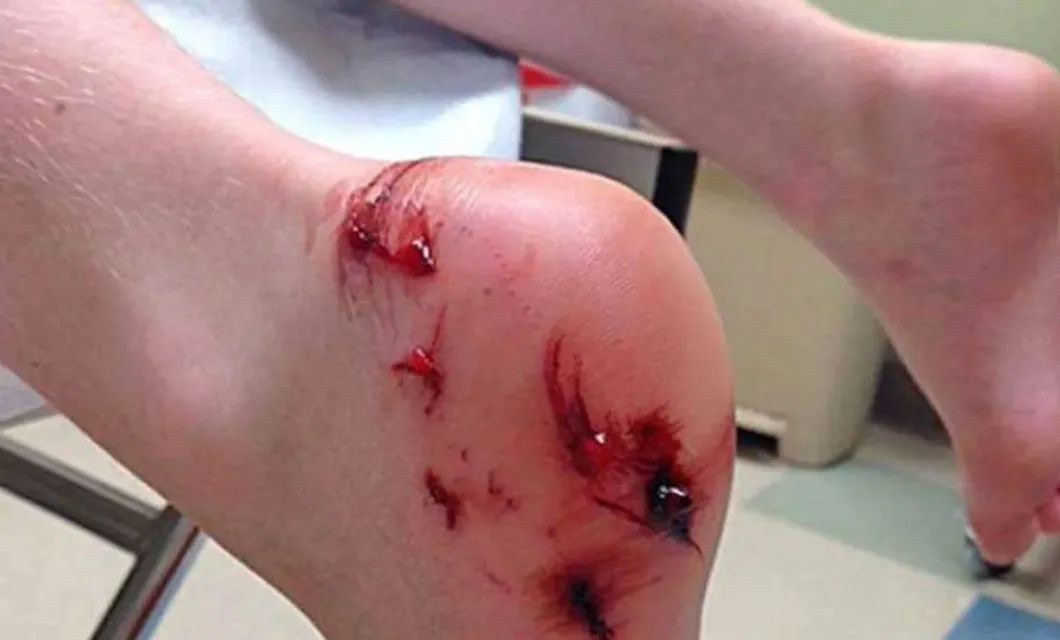 低鳍真鲨造成的咬痕.08nola.com